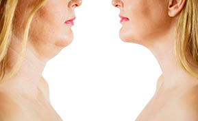 Exilis Skin Tightening Newark DE